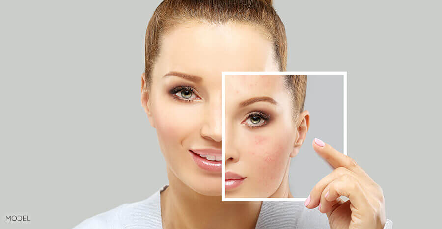Acne scar treatment package - $540