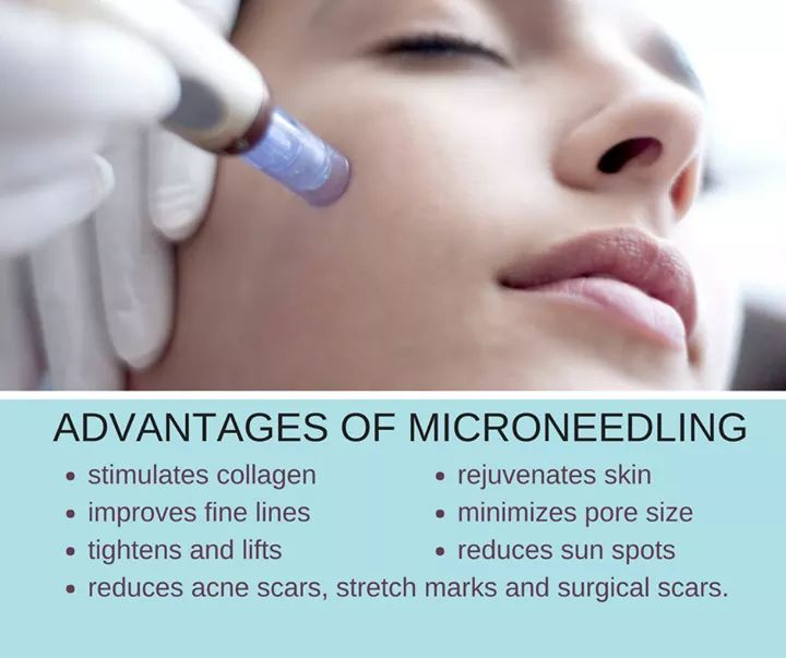 Microneedling